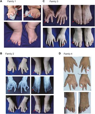 Clinical and genetic analysis in Chinese families with synpolydactyly, and cellular localization of HOXD13 with different length of polyalanine tract